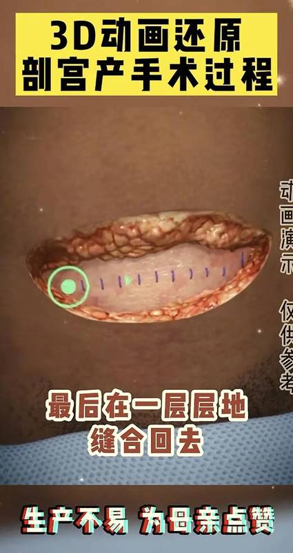 「生命故事·情感共鸣」:当妈后才懂——剖腹产那一刀,究竟划开了什么? 情感心理