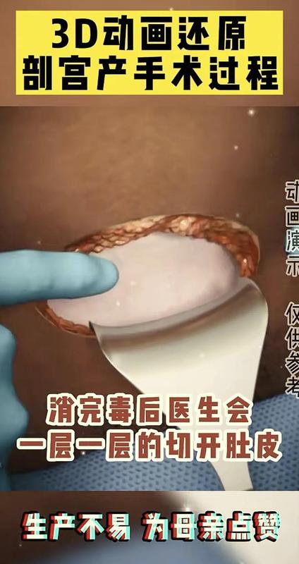 「生命故事·情感共鸣」:当妈后才懂——剖腹产那一刀,究竟划开了什么? 情感心理