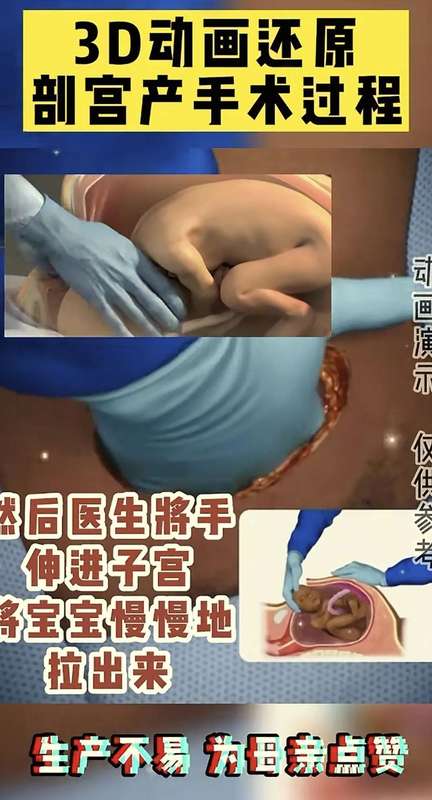 「生命故事·情感共鸣」:当妈后才懂——剖腹产那一刀,究竟划开了什么? 情感心理